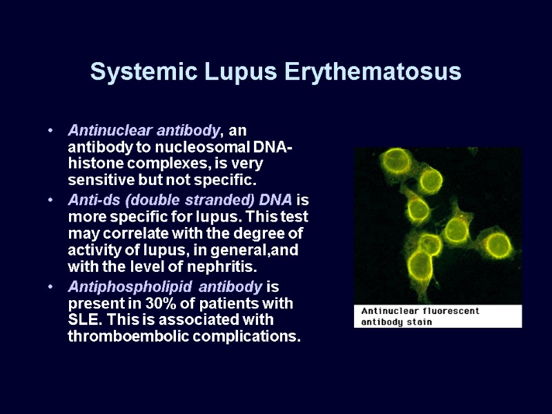 Systemic Lupus Erythematosus Antinuclear antibody, an antibody to nucleosomal DNA-histone complexes, is very sensitive